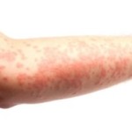 Atopowe zapalenie skóry jest to genetycznie uwarunkowana choroba skóry